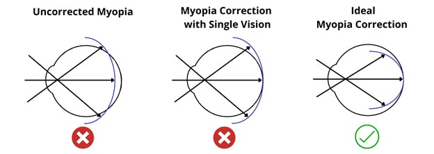 Causes_Myopia