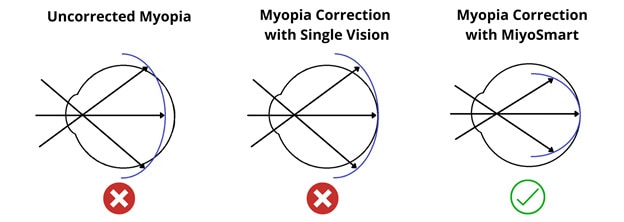 Myopia-Control-Spectacles (1)