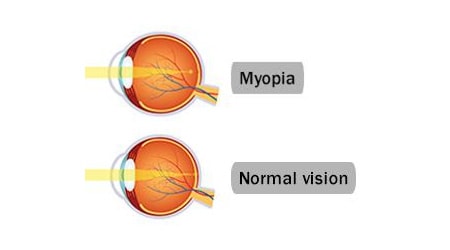 Myopia image