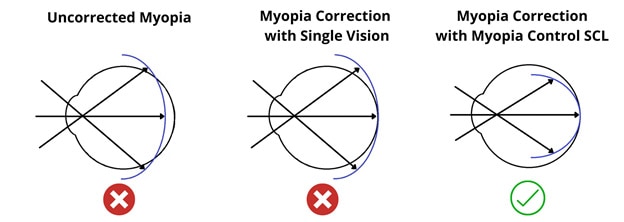 Soft-Myopia